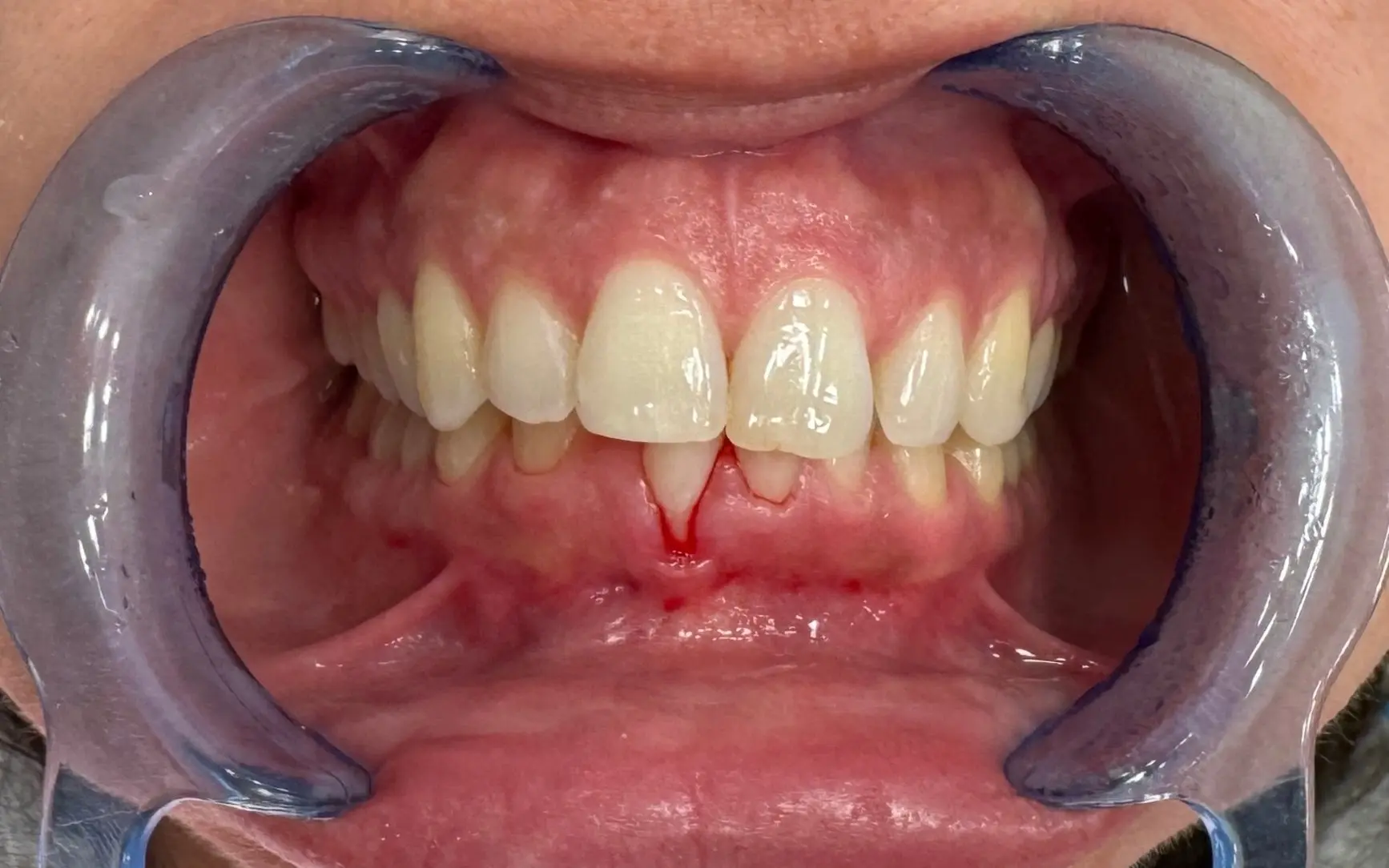 Before treatment