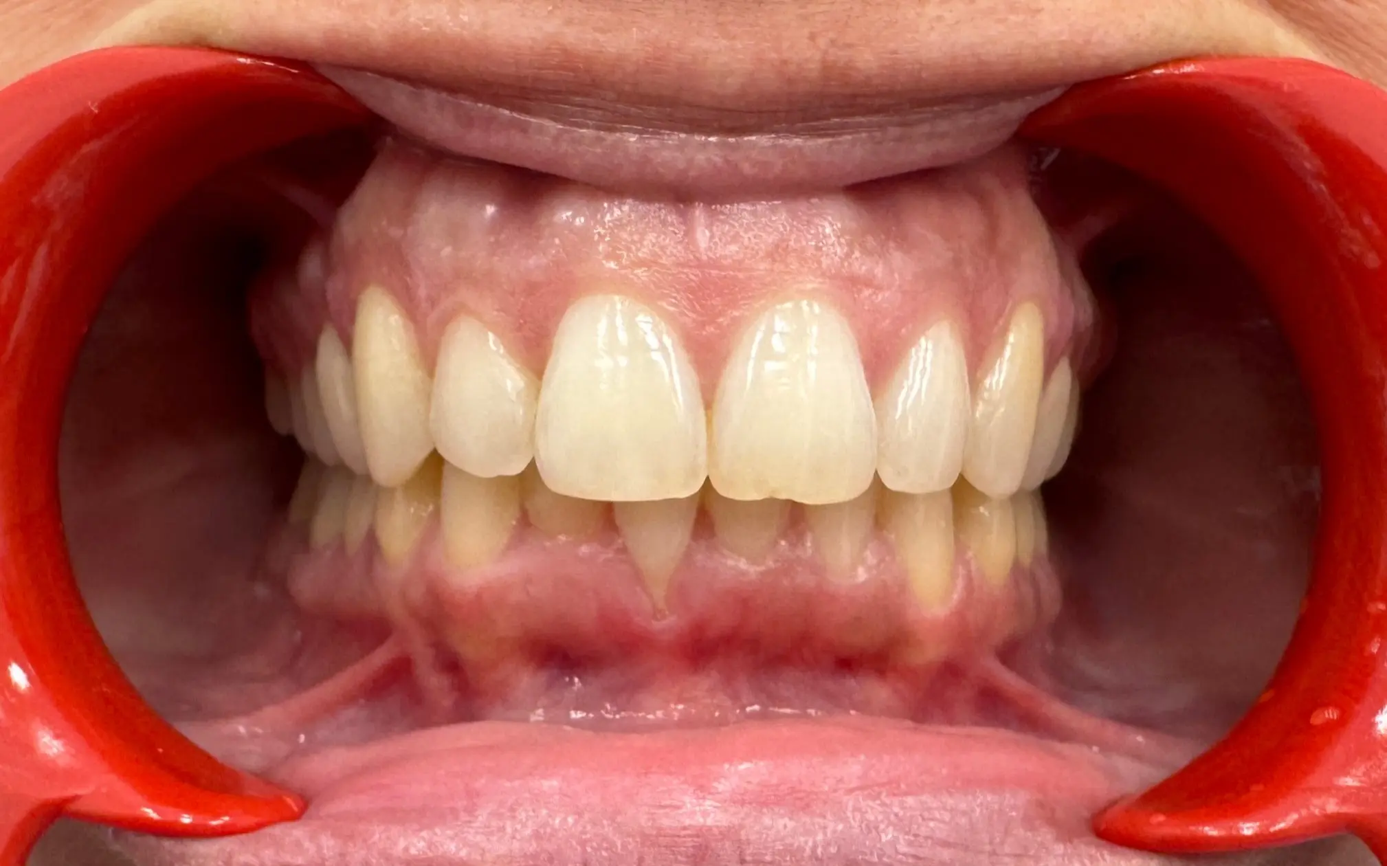 After treatment