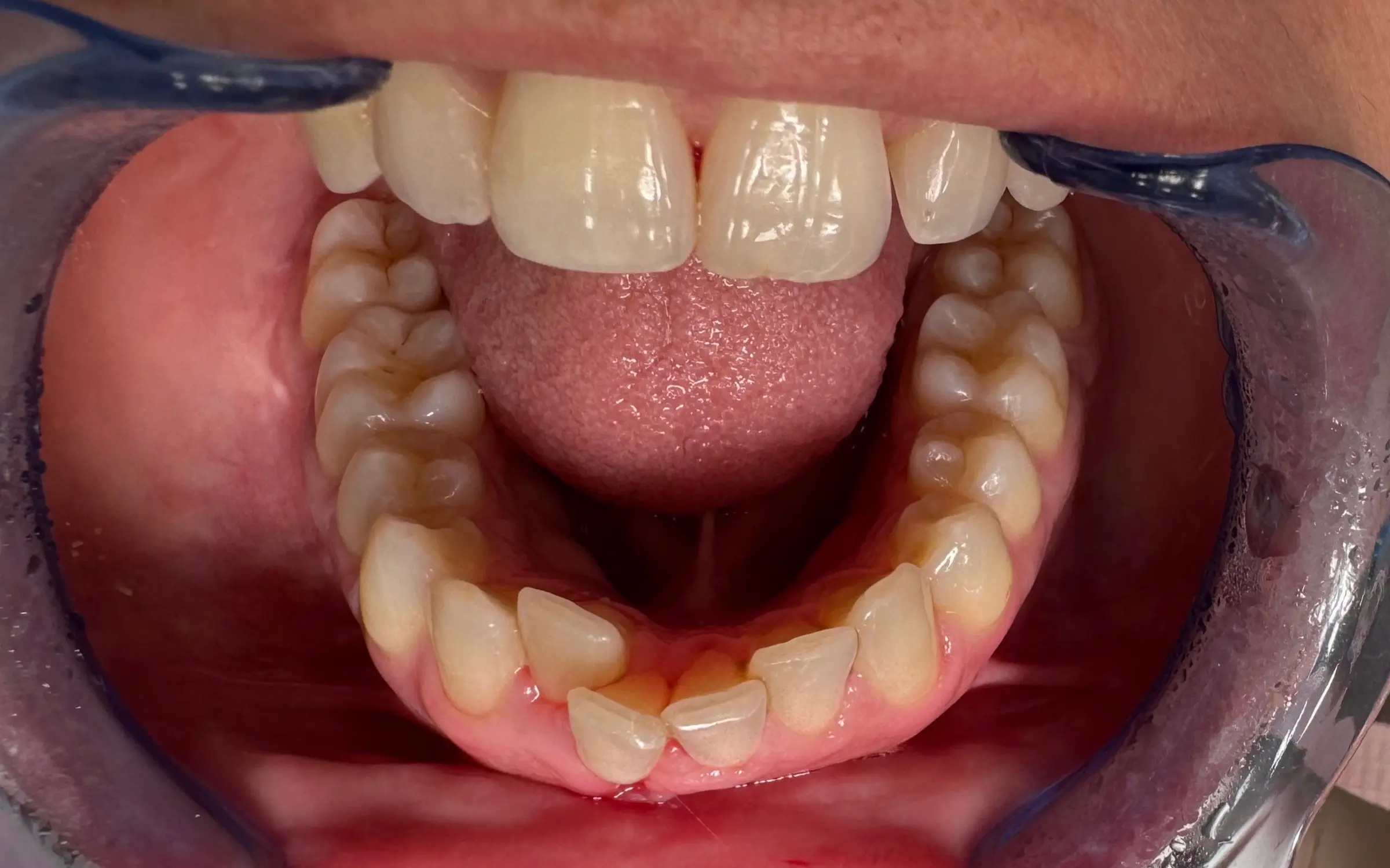 Before treatment